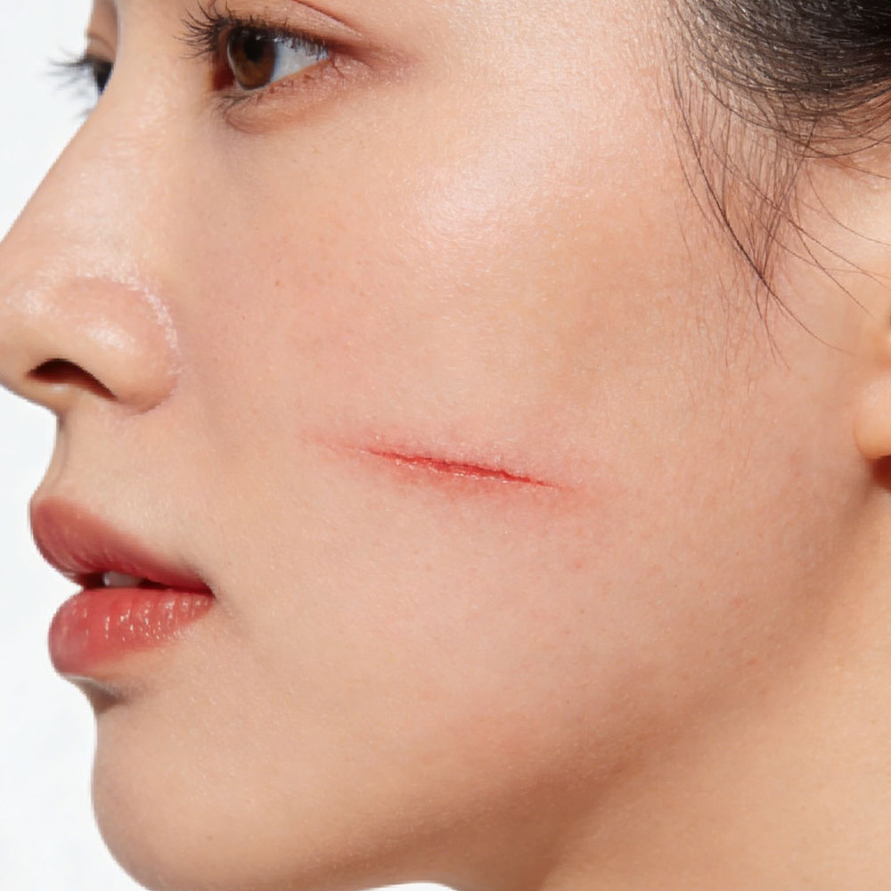 还原光滑肌肤，疤痕修复