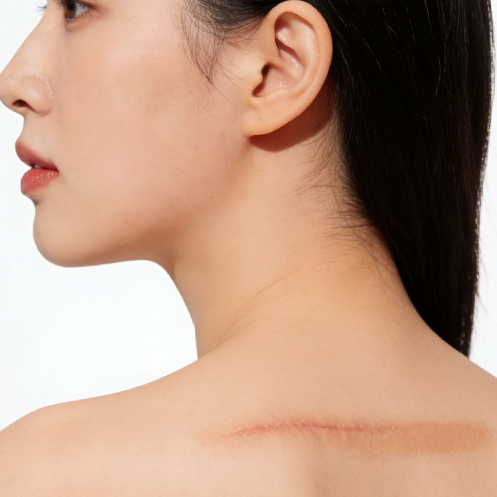 还原光滑肌肤，疤痕修复